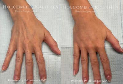 Fillers Before & After Gallery - Patient 154108485 - Image 1