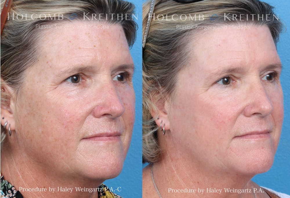   HALO Hybrid Fractional Laser Before & After Gallery - Patient 157104216 - Image 2