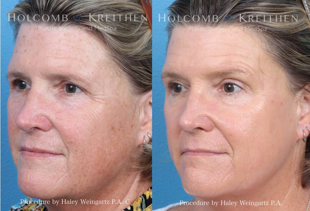   HALO Hybrid Fractional Laser Before & After Gallery - Patient 157104216 - Image 3