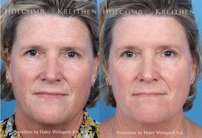   HALO Hybrid Fractional Laser Before & After Gallery - Patient 157104216 - Image 1