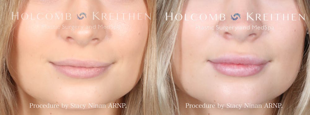 Fillers Before & After Gallery - Patient 162335380 - Image 1