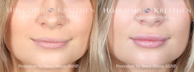 Fillers Before & After Gallery - Patient 162335380 - Image 1