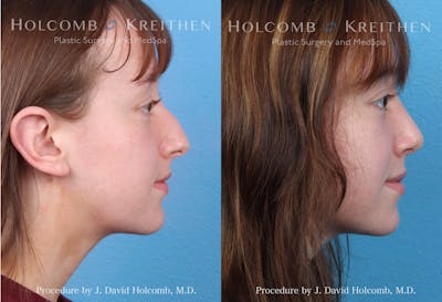 Rhinoplasty Before & After Gallery - Patient 162335388 - Image 1