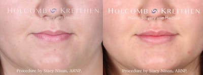 Fillers Before & After Gallery - Patient 165025272 - Image 1