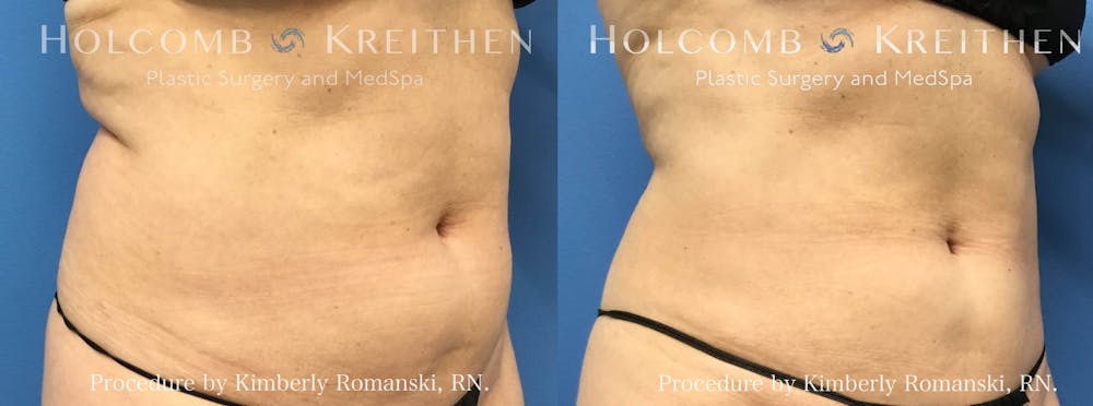 Coolsculpting Before & After Gallery - Patient 147779 - Image 1