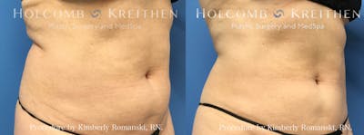 Coolsculpting Before & After Gallery - Patient 147779 - Image 1