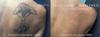 PicoPlus Tattoo Removal Before & After Gallery - Patient 280615 - Image 1