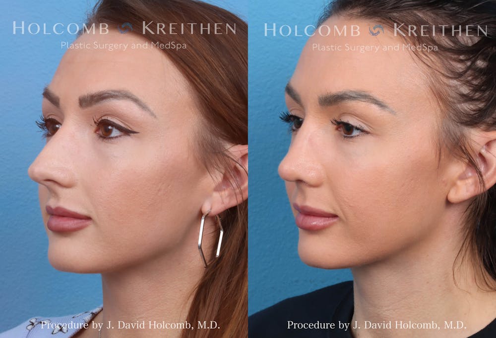 Rhinoplasty Before & After Gallery - Patient 369688 - Image 2