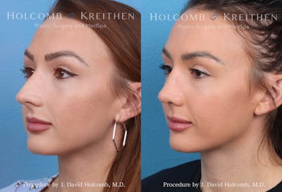 Rhinoplasty Before & After Gallery - Patient 369688 - Image 2