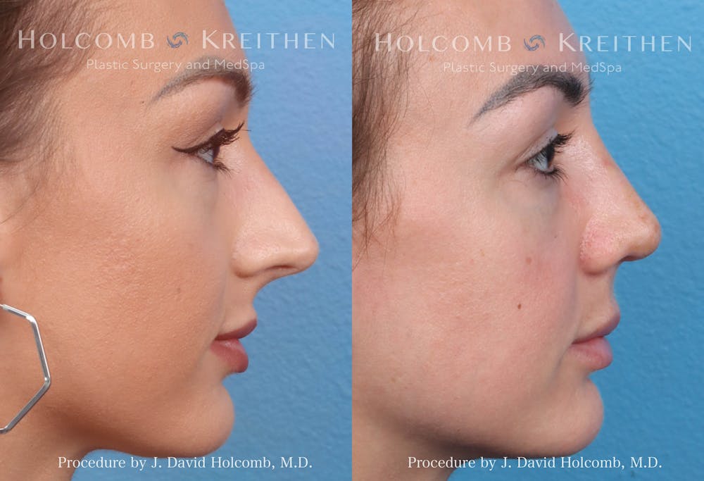 Rhinoplasty Before & After Gallery - Patient 369688 - Image 3