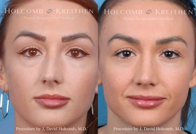 Rhinoplasty Before & After Gallery - Patient 369688 - Image 1