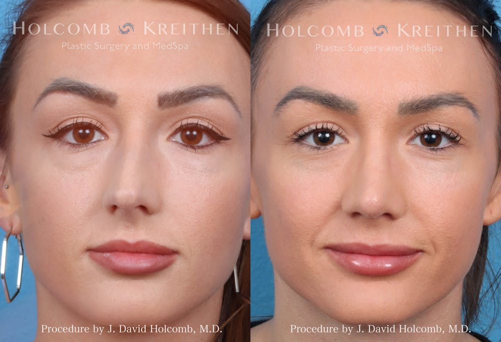 Rhinoplasty Before & After Gallery - Patient 369688 - Image 1