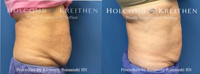 Coolsculpting Before & After Gallery - Patient 237092 - Image 1