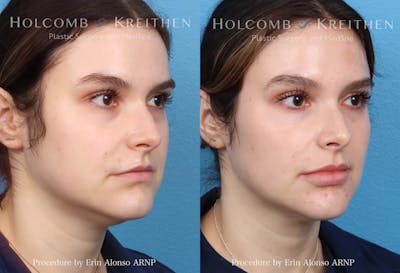 Fillers Before & After Gallery - Patient 150782 - Image 1