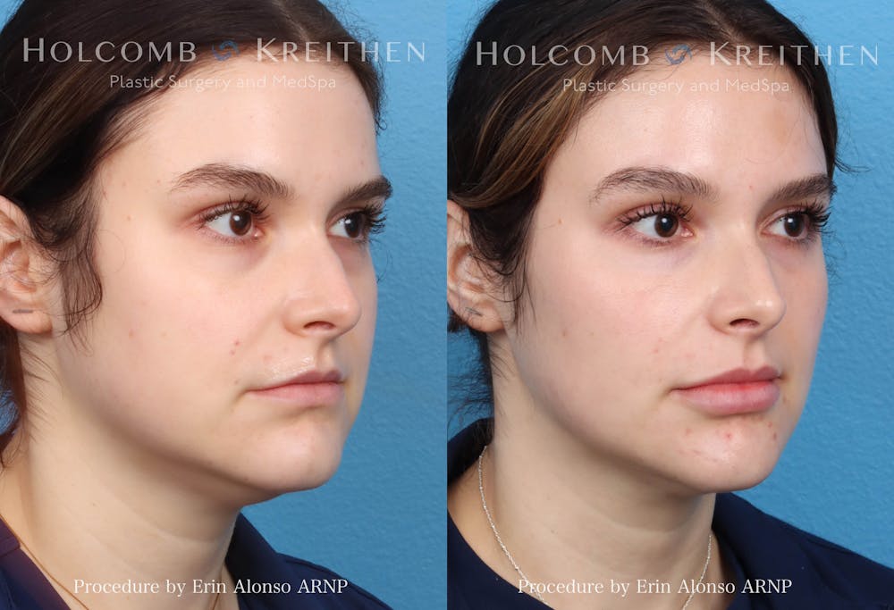 Fillers Before & After Gallery - Patient 150782 - Image 1