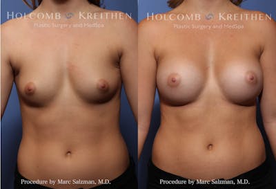 Breast Augmentation Before & After Gallery - Patient 423921 - Image 1