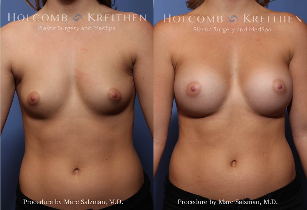 Breast Augmentation Before & After Gallery - Patient 423921 - Image 1