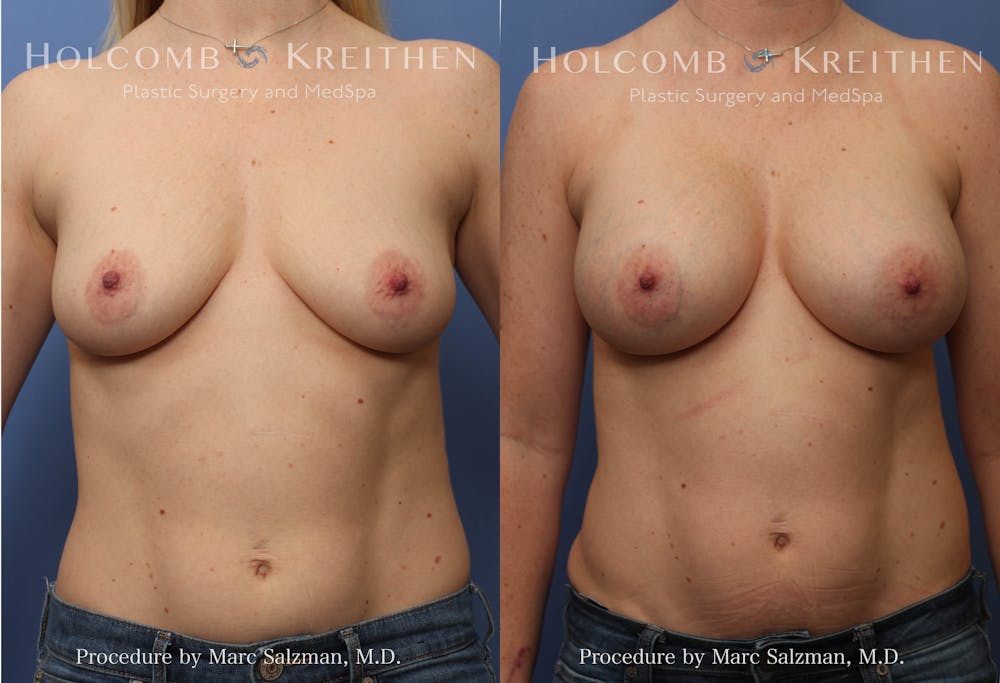 Breast Augmentation Before & After Gallery - Patient 148127 - Image 1