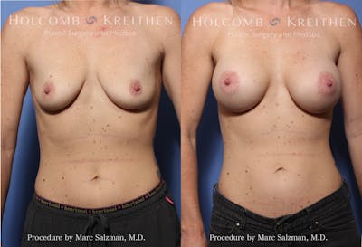 Breast Augmentation Before & After Gallery - Patient 215517 - Image 1