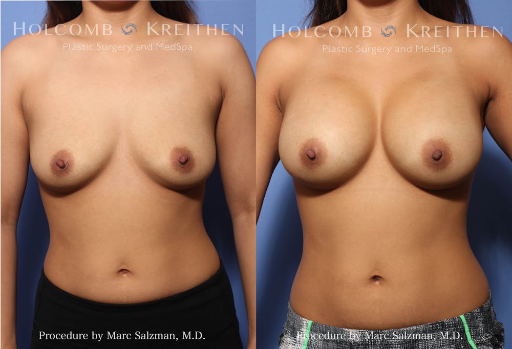 breast implants before and after surgery of a woman