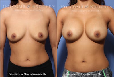 breast implants before and after surgery of a woman