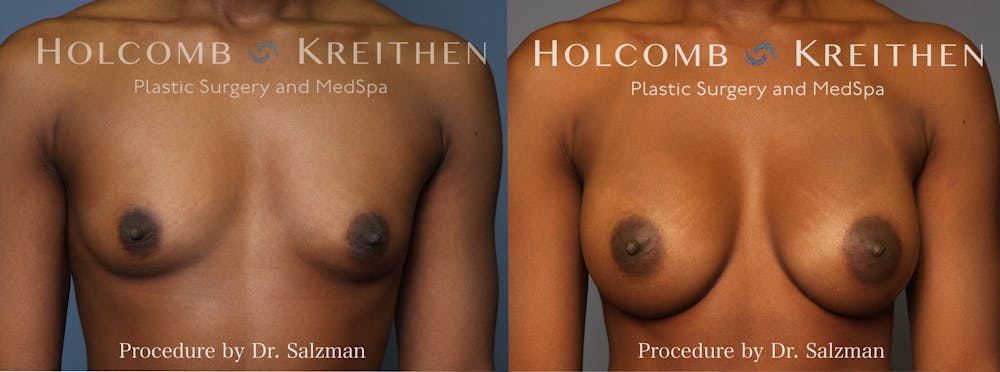 breast implants before and after surgery of a woman