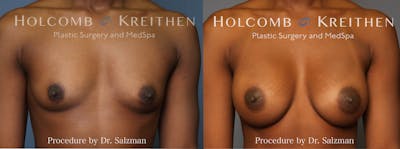 breast implants before and after surgery of a woman