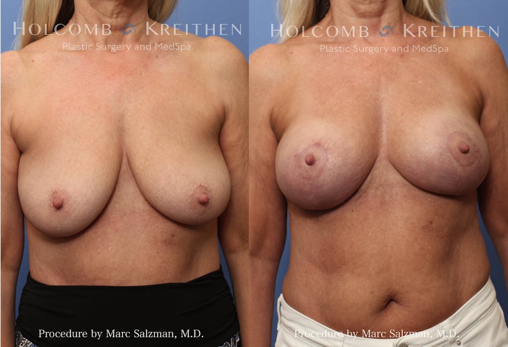 breast implants before and after surgery of a woman