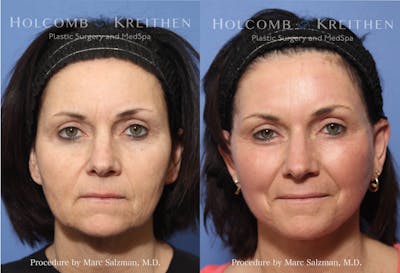 there are two pictures of a woman with a facelift before and after surgery