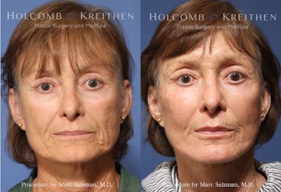 there are two pictures of a woman with wrinkles on her face