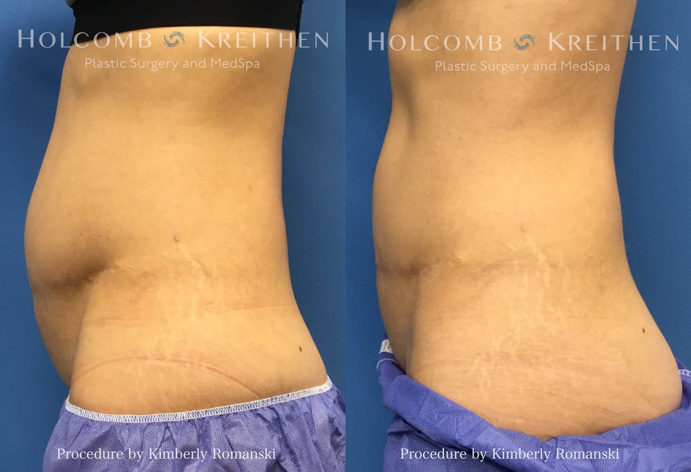 Coolsculpting Before & After Gallery - Patient 387367 - Image 1