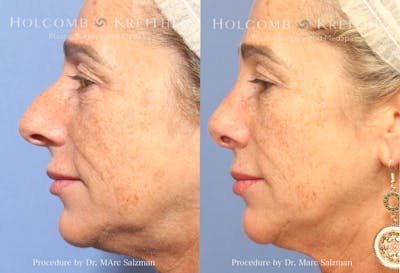 Rhinoplasty Before & After Gallery - Patient 314040 - Image 1