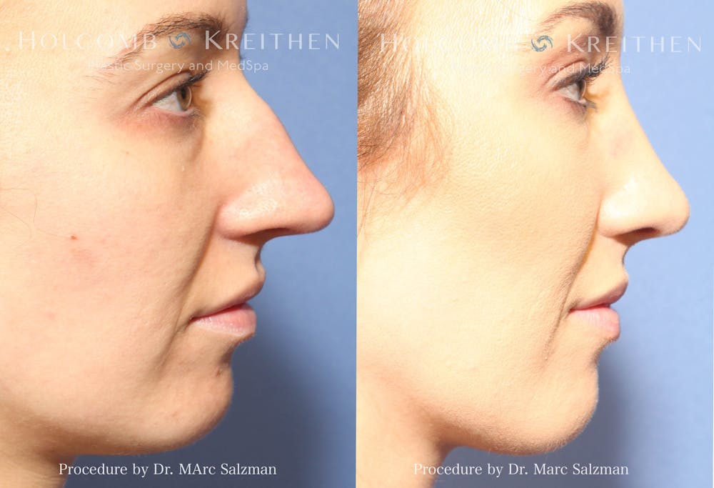 Rhinoplasty Before & After Gallery - Patient 420168 - Image 1