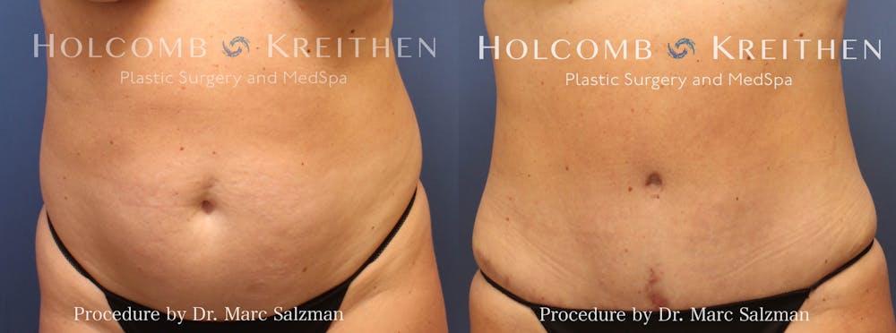 Tummy Tuck Before & After Gallery - Patient 244610 - Image 1