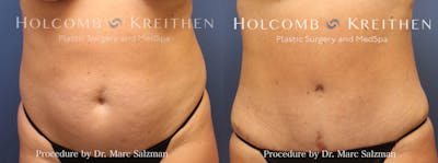 Tummy Tuck Before & After Gallery - Patient 244610 - Image 1