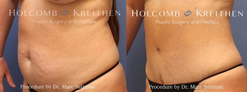 Tummy Tuck Before & After Gallery - Patient 244610 - Image 2