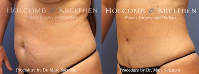 Tummy Tuck Before & After Gallery - Patient 244610 - Image 2