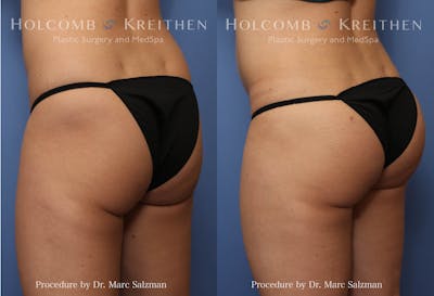 Brazilian Butt Lift Before & After Gallery - Patient 539213 - Image 1
