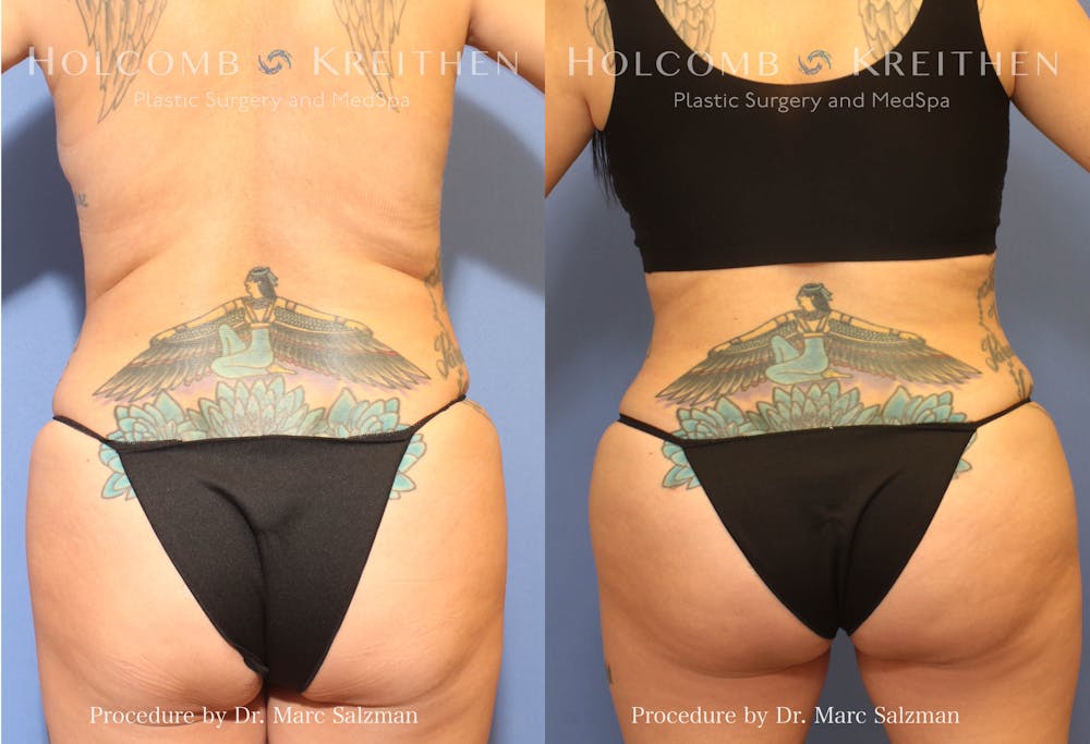 Brazilian Butt Lift Before & After Gallery - Patient 201733 - Image 1