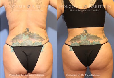 Brazilian Butt Lift Before & After Gallery - Patient 201733 - Image 1