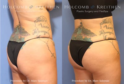 Brazilian Butt Lift Before & After Gallery - Patient 201733 - Image 2