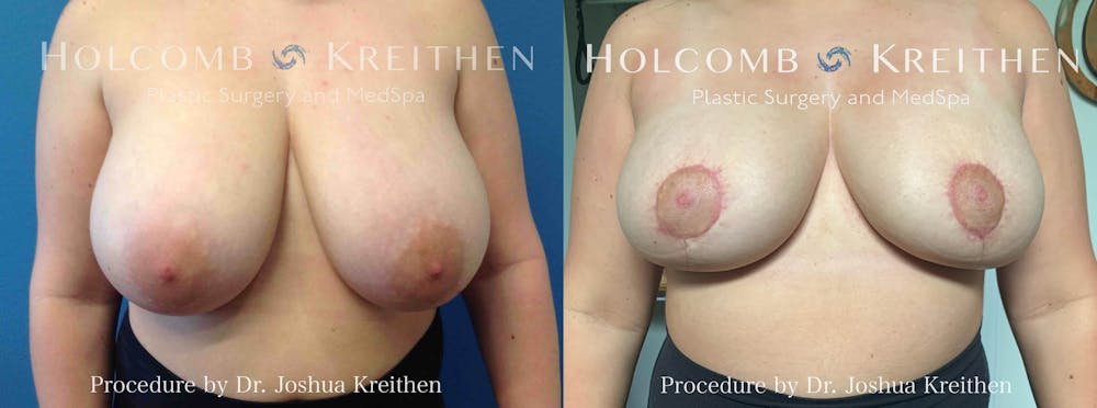 Breast Reduction Before & After Gallery - Patient 193715 - Image 1