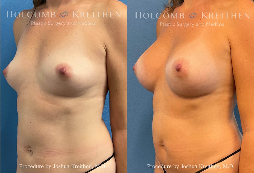 Breast Reduction Before & After Gallery - Patient 186713 - Image 2