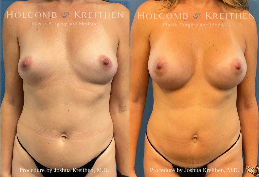 Breast Reduction Before & After Gallery - Patient 186713 - Image 1