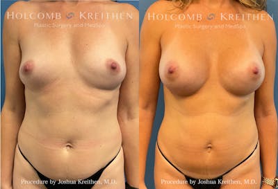 Breast Reduction Before & After Gallery - Patient 186713 - Image 1