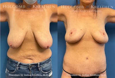 Breast Lift Before & After Gallery - Patient 407148 - Image 1