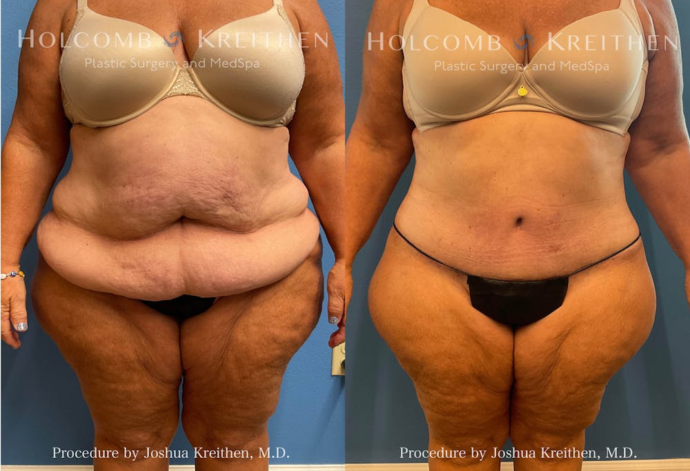 Tummy Tuck Before & After Gallery - Patient 412259 - Image 1