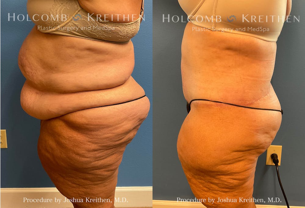 Tummy Tuck Before & After Gallery - Patient 412259 - Image 2