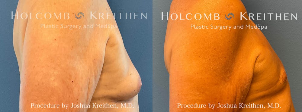 Gynecomastia Before & After Gallery - Patient 403278 - Image 2
