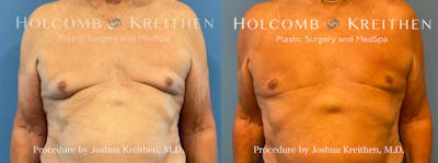 Gynecomastia Before & After Gallery - Patient 403278 - Image 1